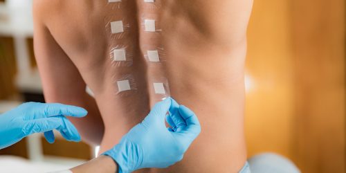 Immunologist Doing Skin Prick Allergy Test on a Woman’s Back
